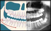 Wisdom teeth removed by Oral Surgeon in Decatur GA
