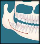 Wisdom Teeth Extracted by Oral Surgeon in Decatur GA