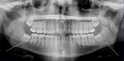 Wisdom Teeth Radiograph by Oral Surgeon in Decatur GA