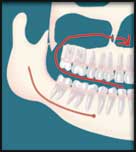 Wisdom Teeth Removed by Oral Surgeon in Decatur GA