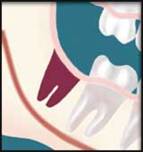 Normal healing after Wisdom tooth Extraction by Oral Surgeon in Decatur GA